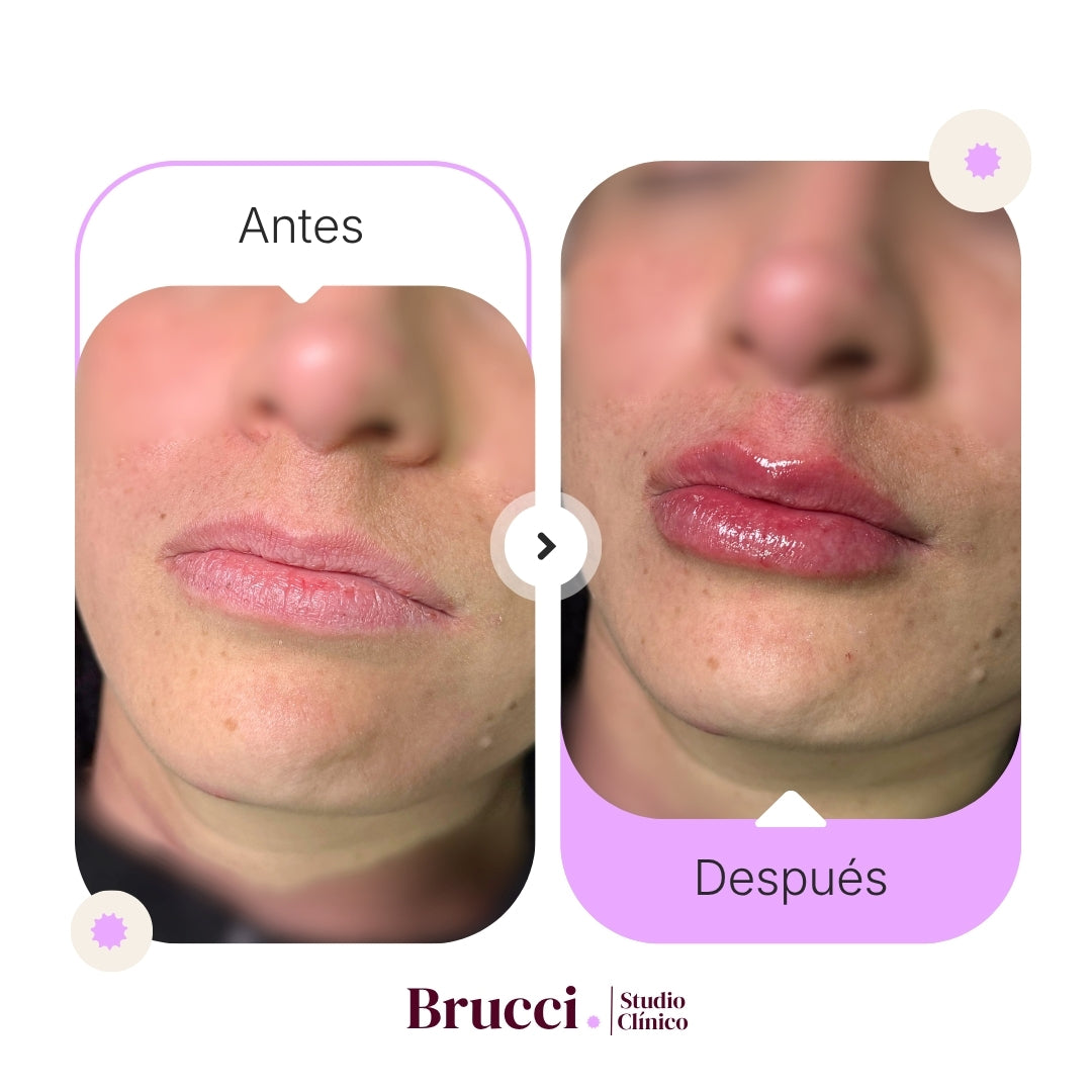 Aumento de labios (1ml)