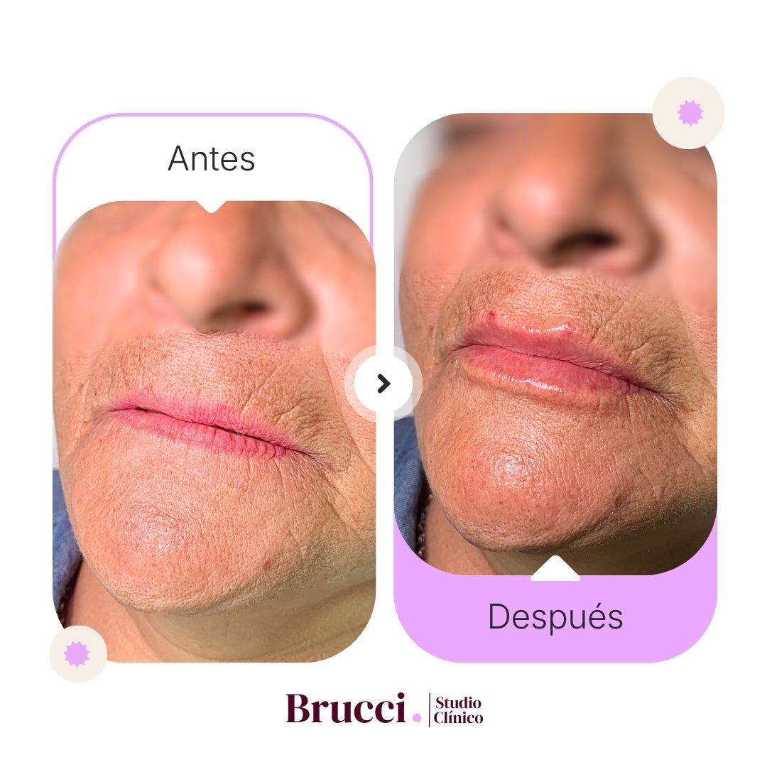 Aumento de labios (1ml)