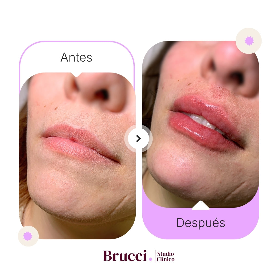 Aumento de labios (1ml)