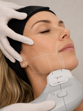 HIFU 12D Full Face (cara, cuello y papada)