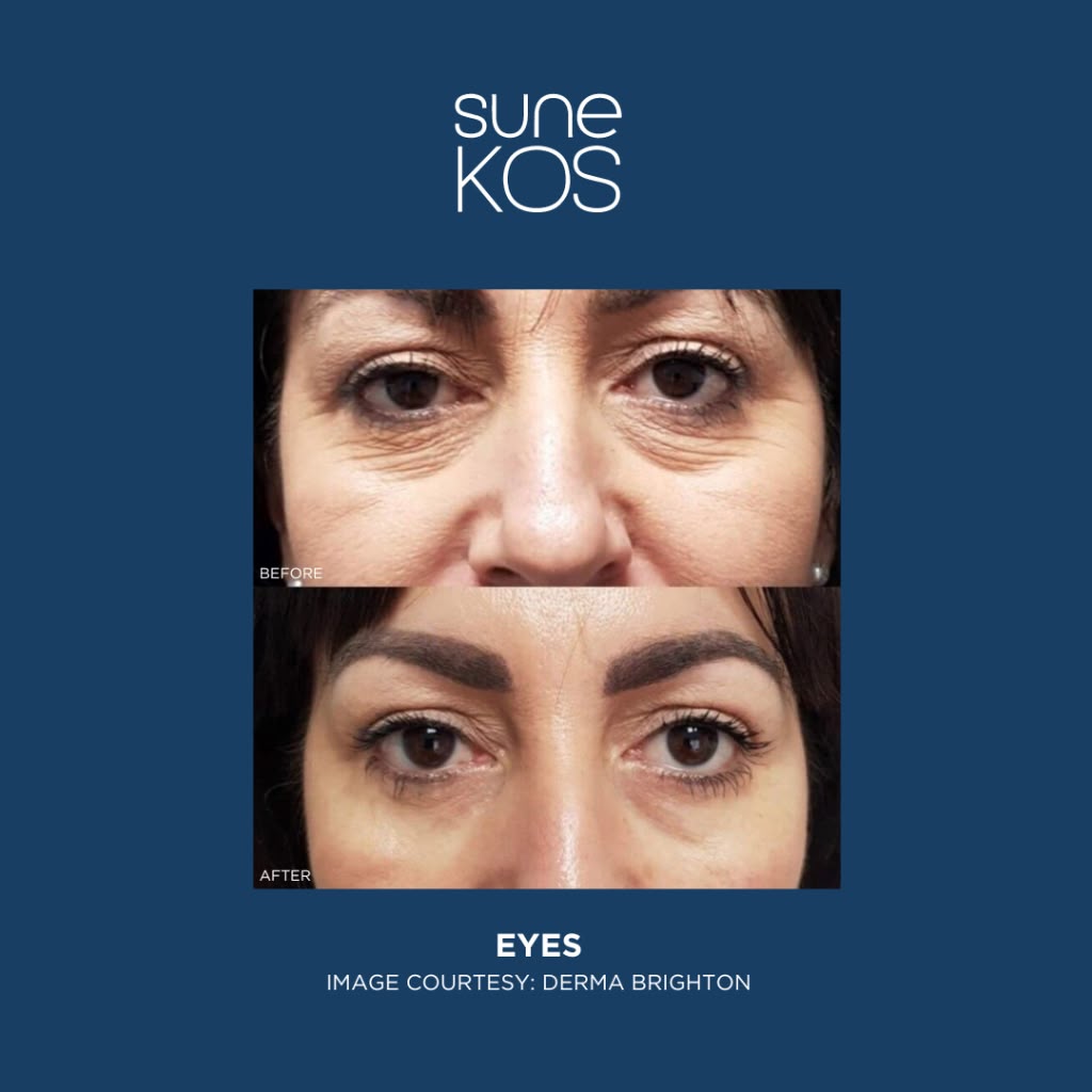 Sunekos | Regenera tus arrugas de Ojeras & Código de Barras