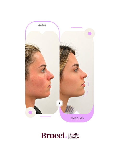 3 Zonas con Ácido Hialurónico - Face Balance (3ml)
