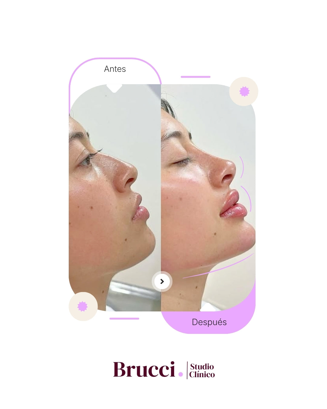 3 Zonas con Ácido Hialurónico - Face Balance (3ml)