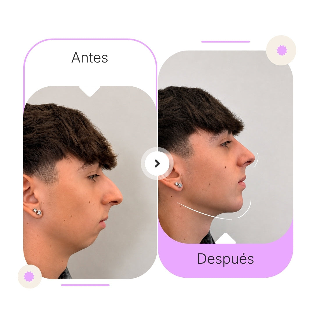 Definición Mandibular con Ácido Hialurónico