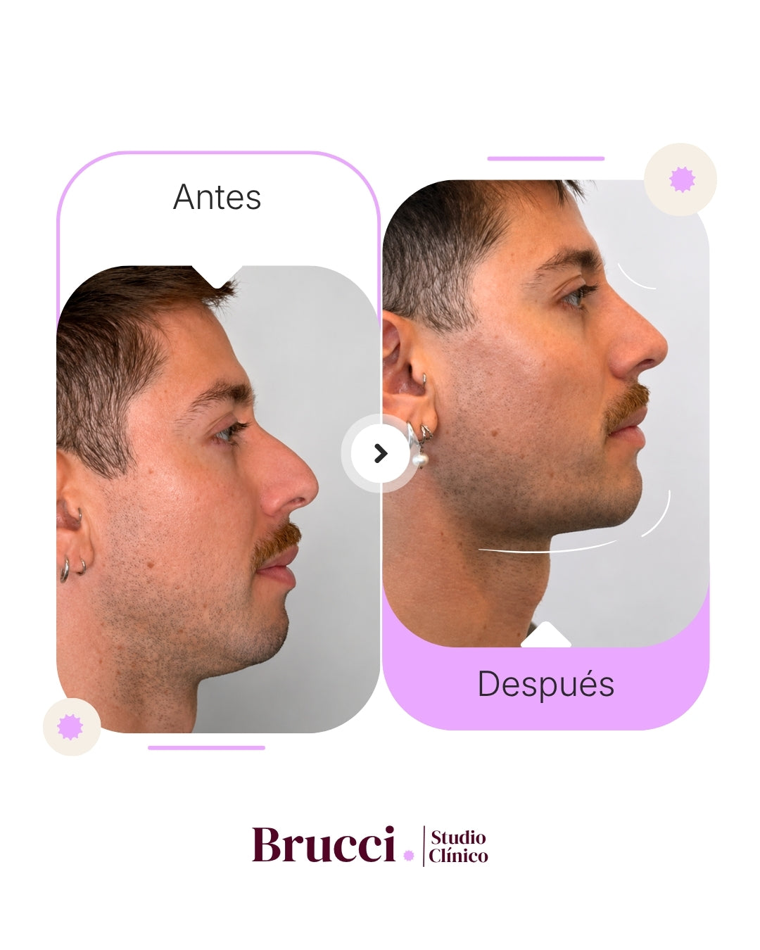 Definición Mandibular con Ácido Hialurónico