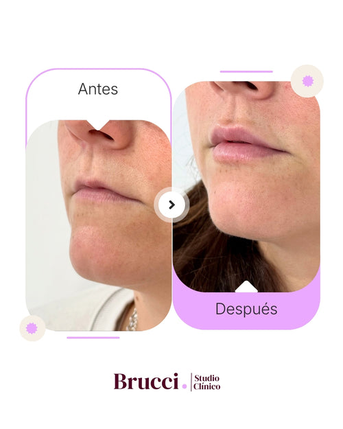 Aumento de labios (1ml)