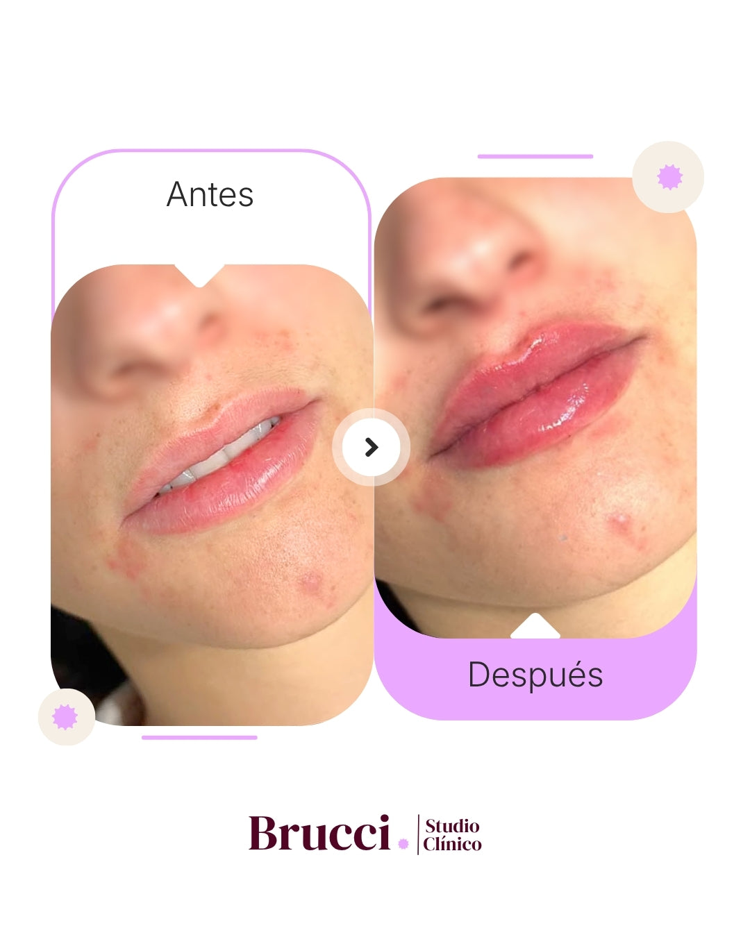 Rinomodelación + Aumento de labios (2ml)