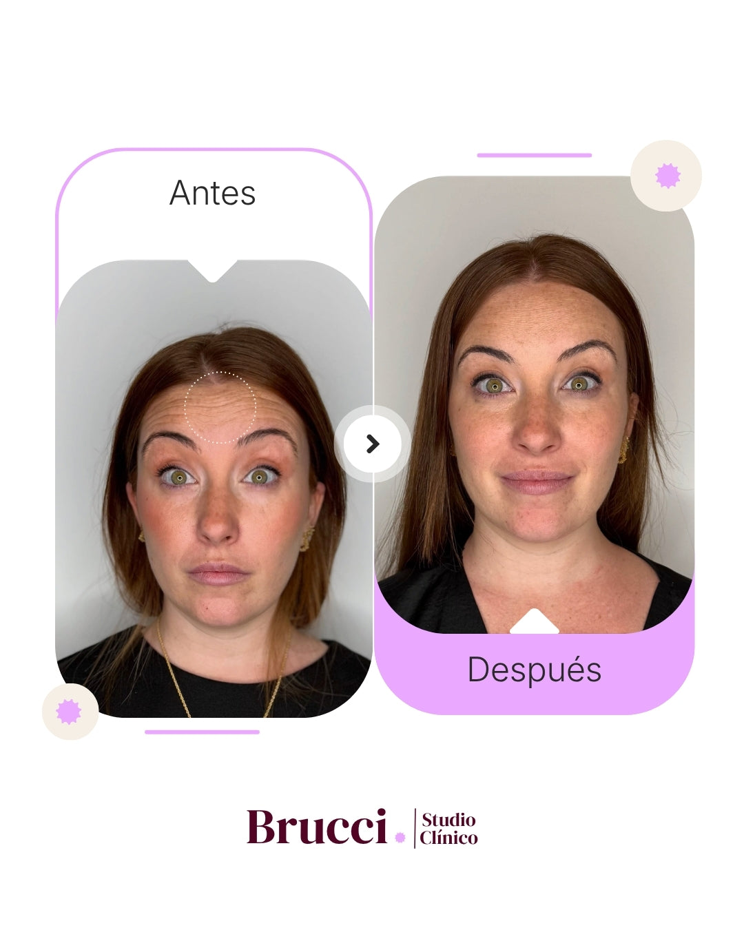 Botox 3 zonas con Dysport