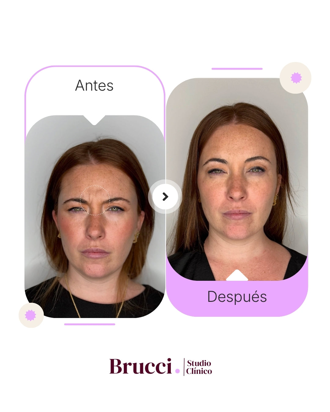 Botox 3 zonas con Dysport