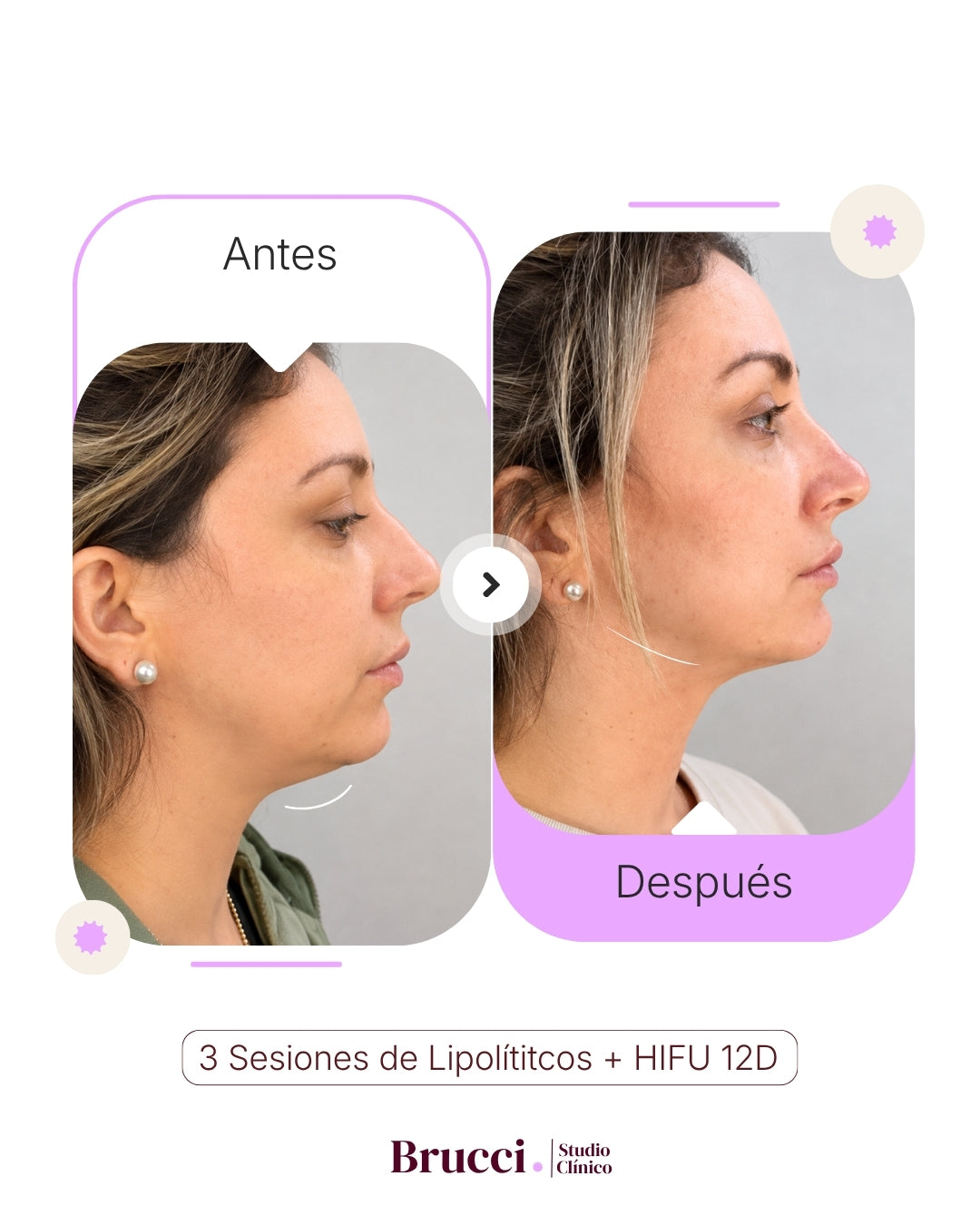 Lipolíticos + HIFU 12D Papada
