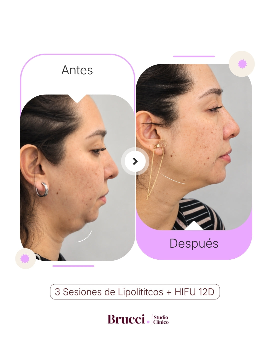 Lipolíticos + HIFU 12D Papada