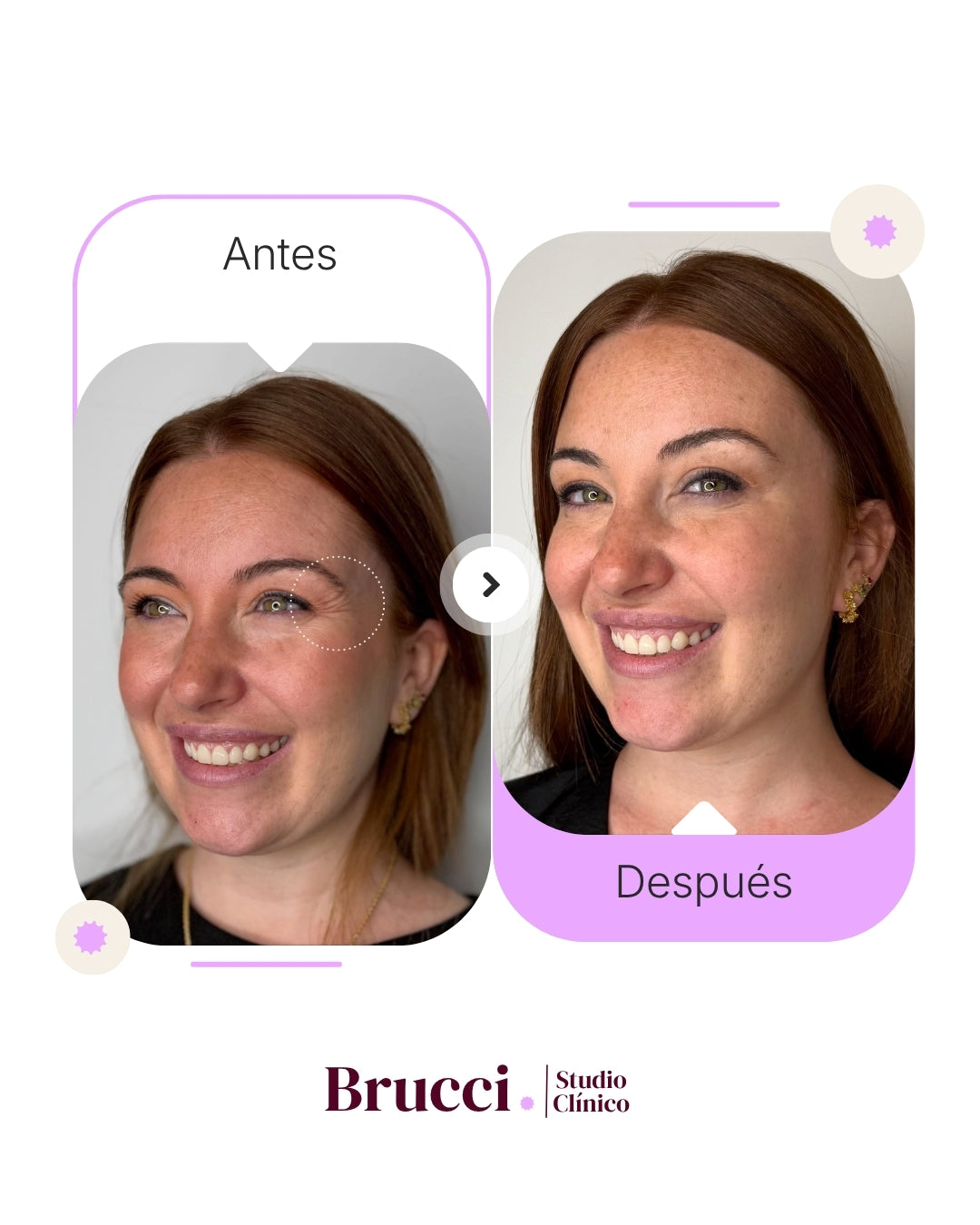 Botox 3 zonas con Dysport