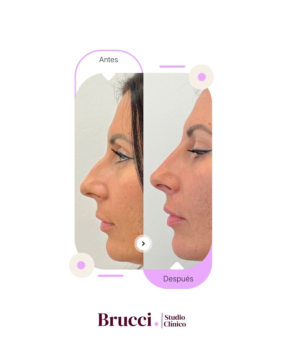 Rinomodelación + Aumento de labios (2ml)