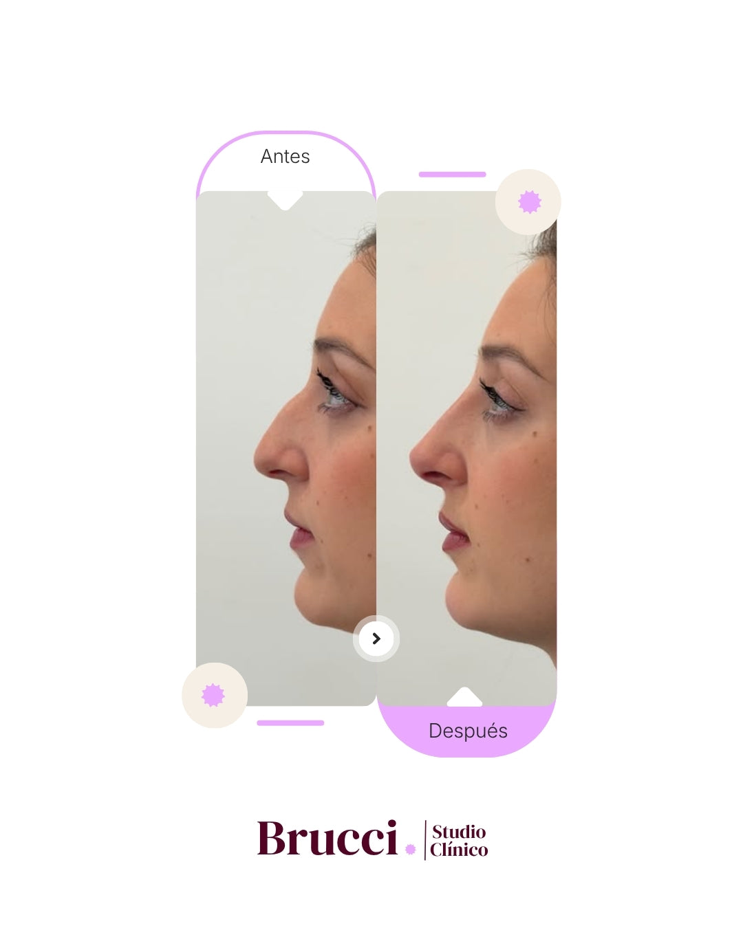 Rinomodelación + Aumento de labios (2ml)
