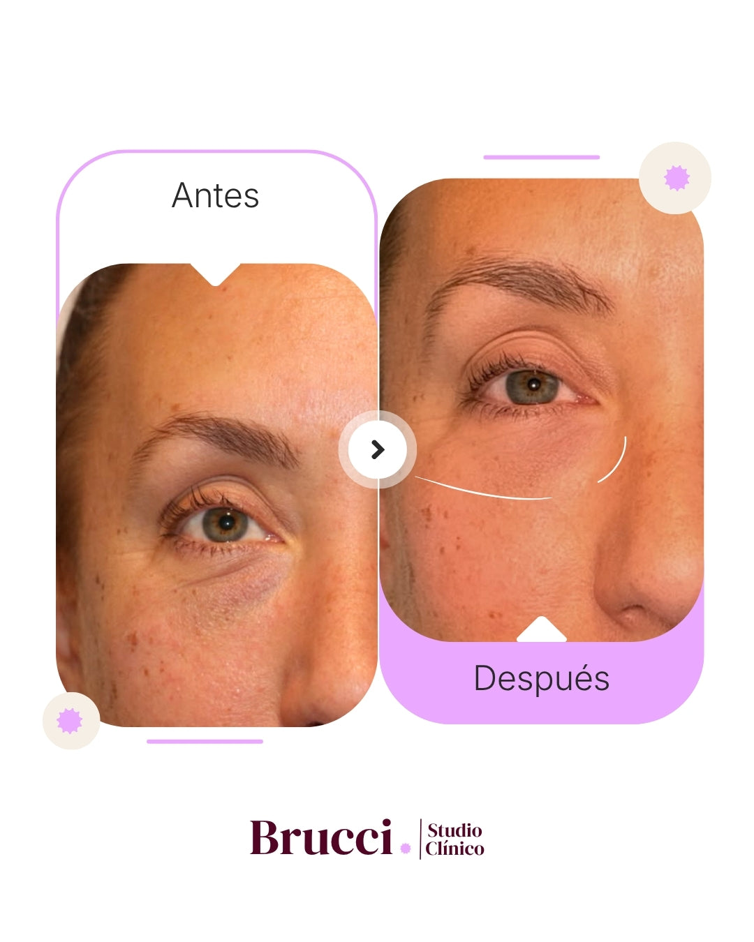 Sunekos | Regenera tus arrugas de Ojeras & Código de Barras